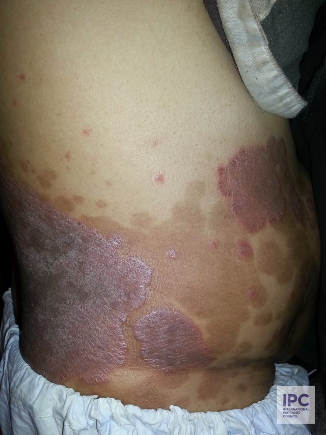 Patient presents with purple lesions.