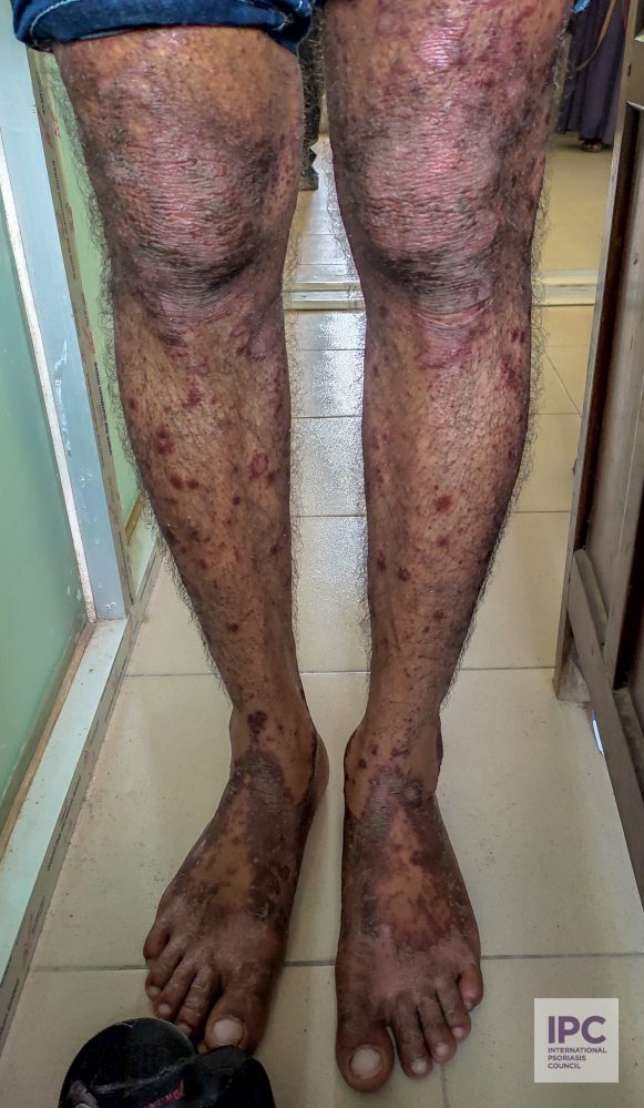 A 38-year-old male patient with plaque psoriasis presented with hyperpigmented plaques on both legs.