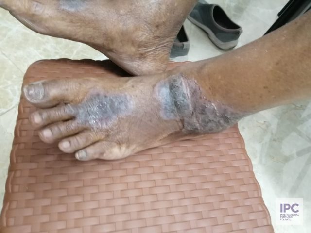 An elderly man presented with purplish plaques with scales that have been present on his legs for 5 years. Upon first presentation, he was treated with topical medicines.