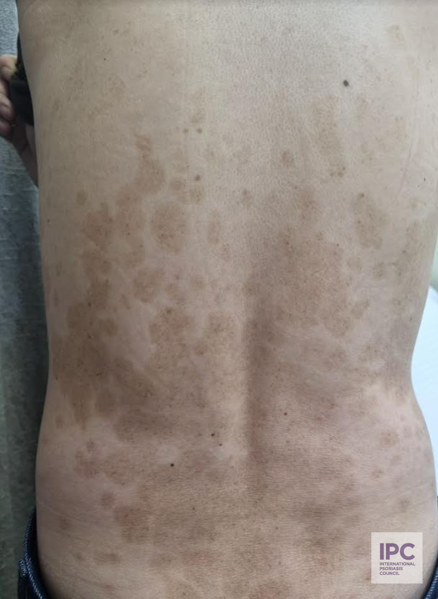A 55-year-old Vietnamese male presented with extensive psoriasis in 2018. He was treated with biologic treatment and achieved complete clearance in 2018. His psoriasis has been clear for 6 years. His post-inflammatory hyperpigmentation has lightened over the years but still remains persistent even after 6 years.