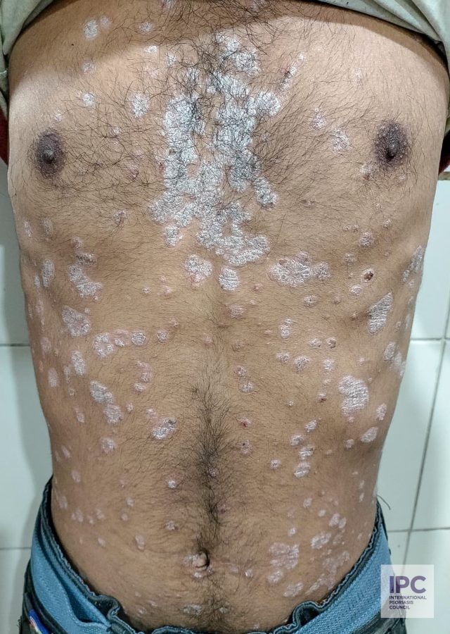 A 28 -year-old male patient with psoriasis vulgaris presented with multiple gray-pink plaques with thick scaling on the trunk.