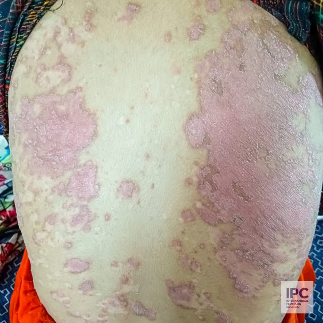 Patient presented with numerous scaly plaques on almost all of her body including her scalp. There was hyperkeratosis of the palms and soles as well.