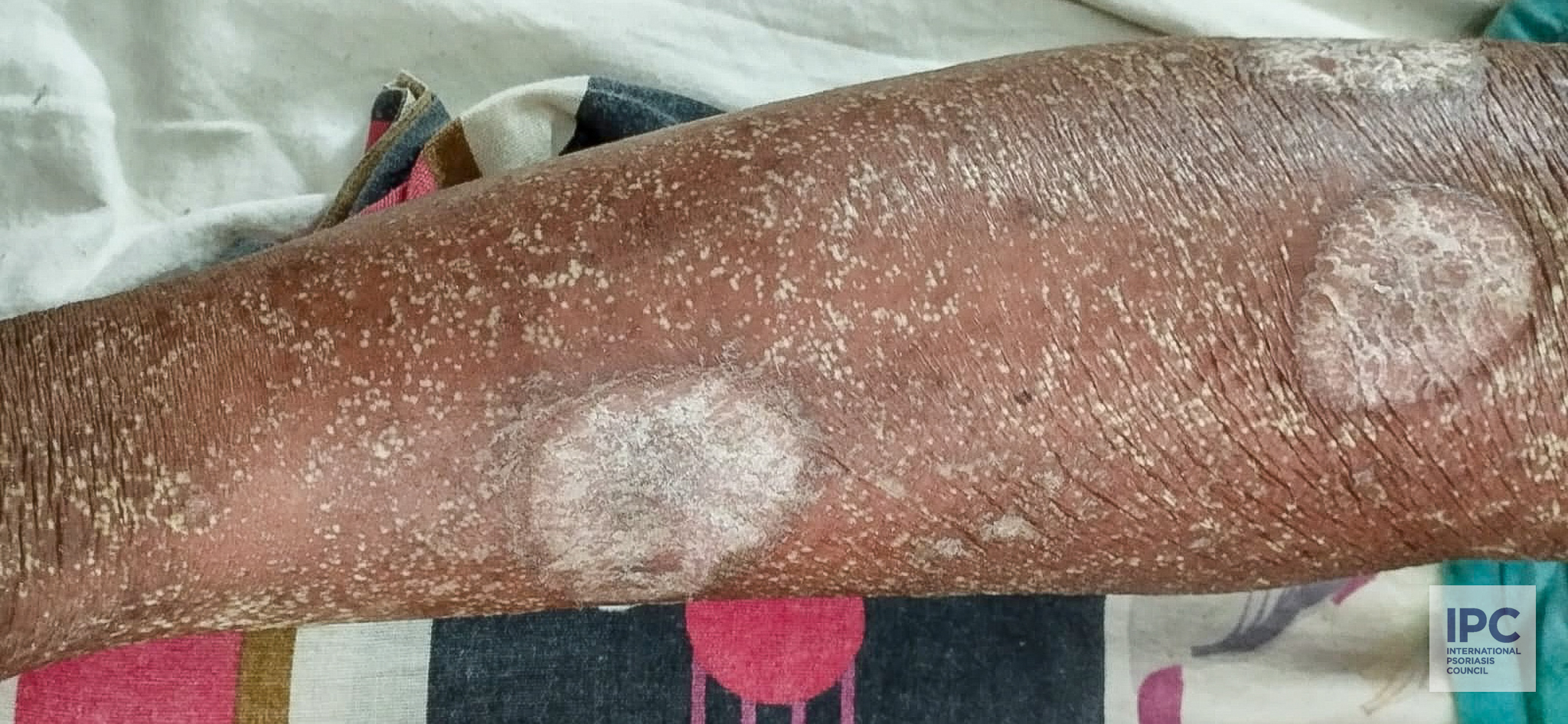 60-year-old male patient with psoriasis vulgaris. Presented with thick scaled gray plaques on both arms and trunk.