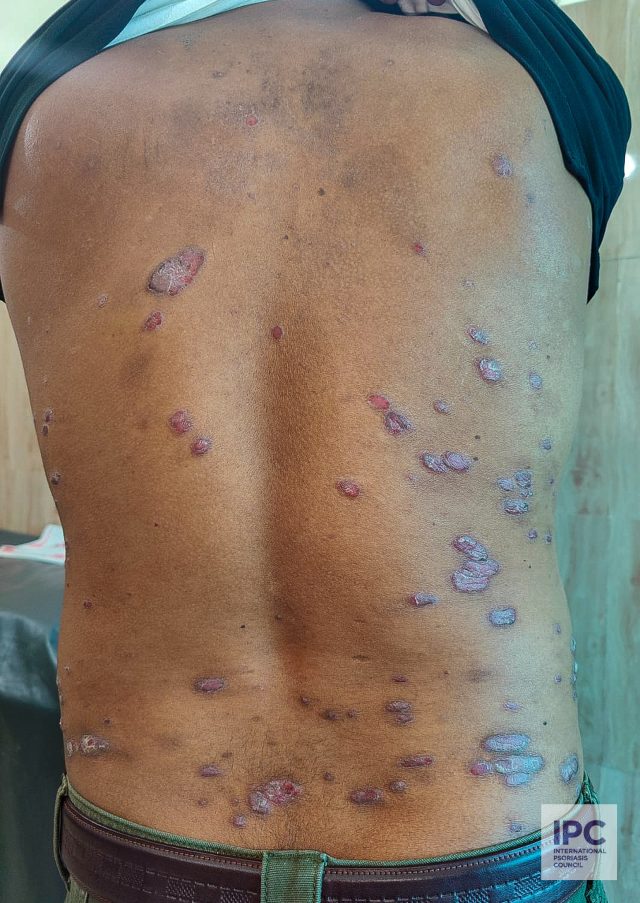 A 34-year-old male patient with plaque psoriasis presented with deep purple plaques with slight scaling on the back of the trunk.