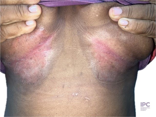 Patient is an Afro-Colombian woman who developed flexural psoriasis several years ago in the axillary, inframammary, inguinal and intergluteal areas. She has a history of multiple topical and oral treatments for fungal infections without resolution. Her medical history includes obesity. She is currently without treatment for psoriasis.