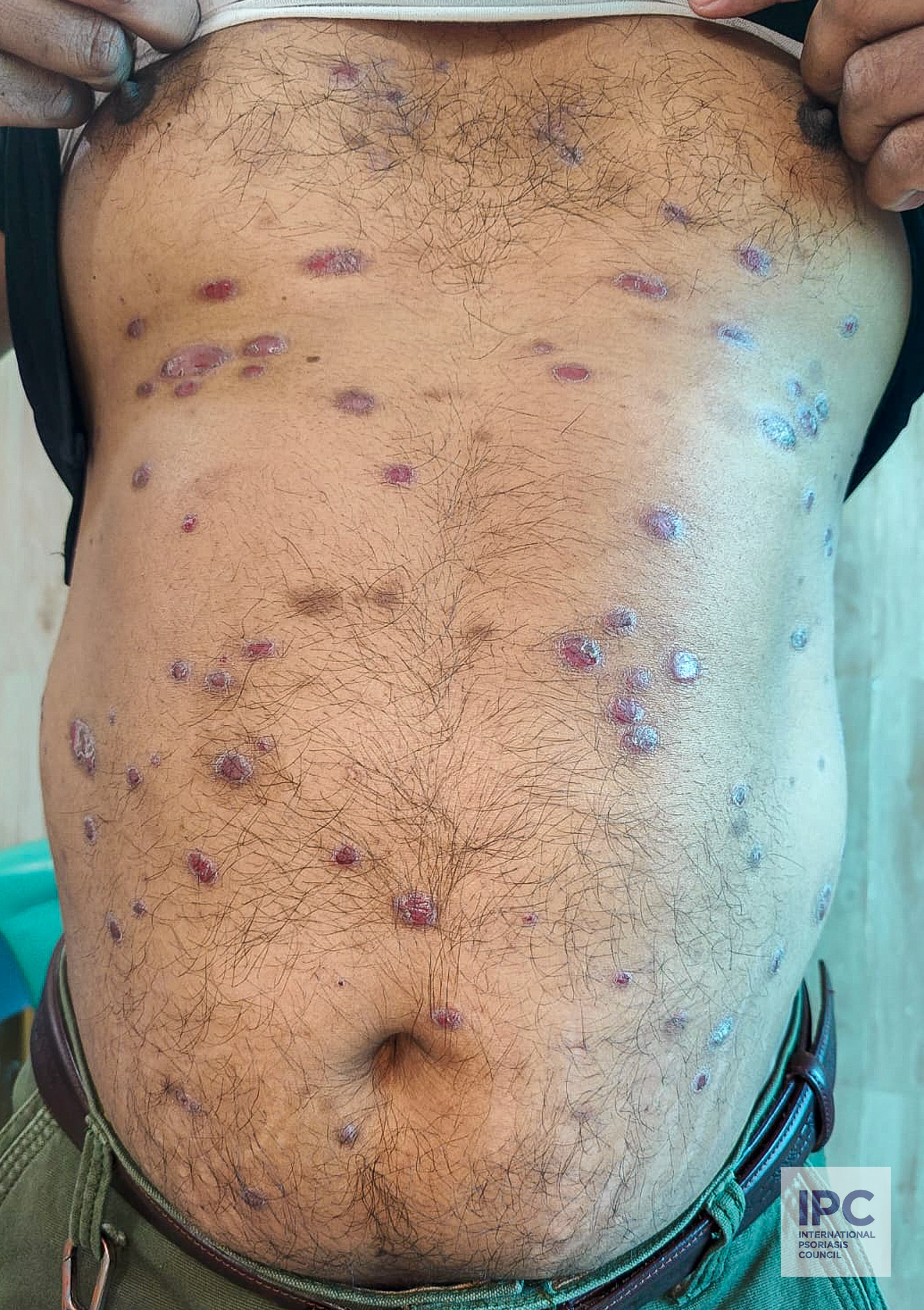 A 34-year-old male patient with plaque psoriasis presented with deep purple plaques with slight scaling on the front of the trunk.