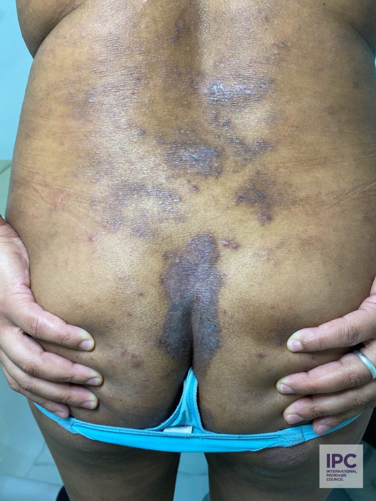Patient has psoriasis confirmed by a skin biopsy. The patient presents with different types of lesions; plaque to patches and some pustular lesions.