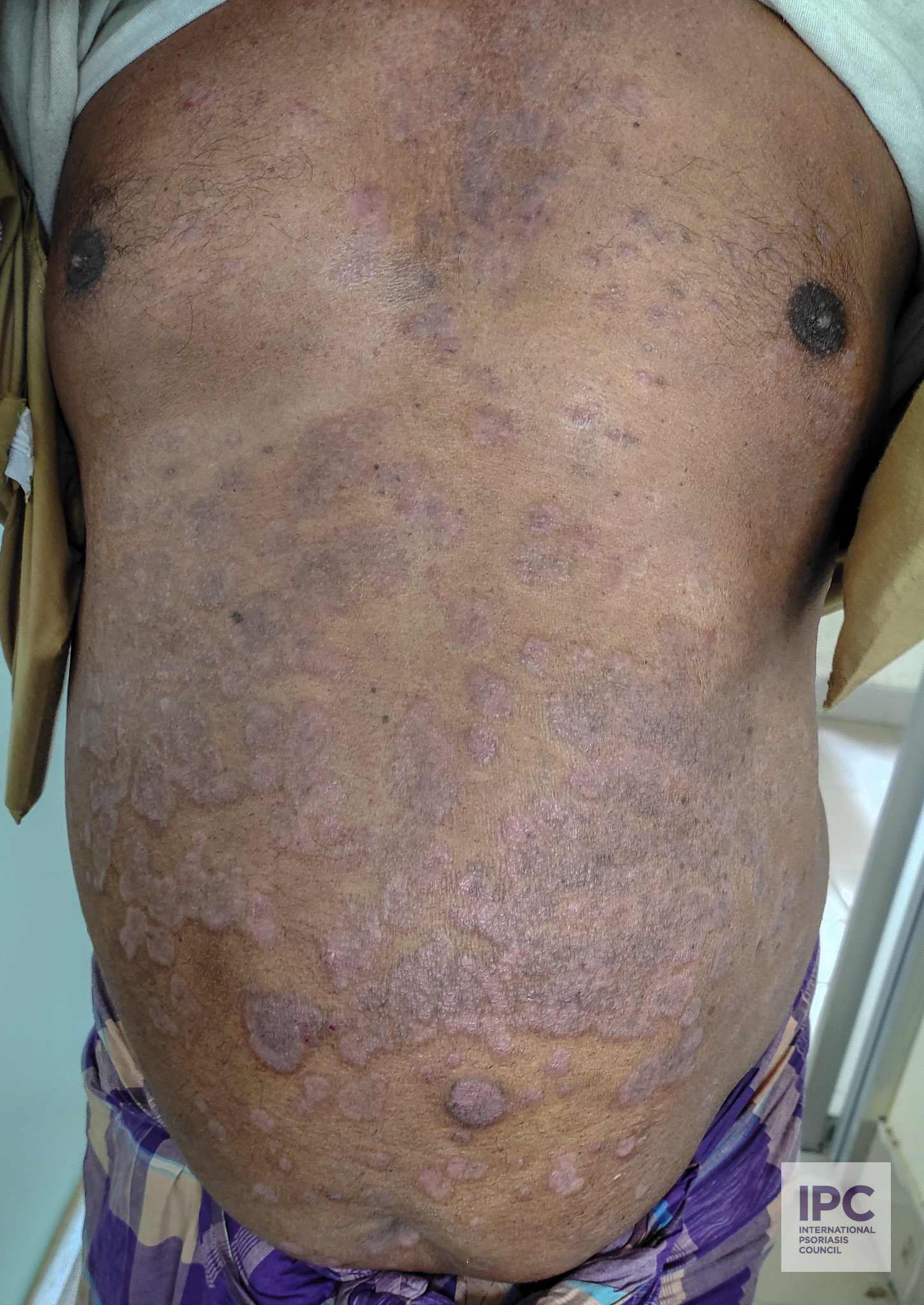 A 52-year-old male patient with psoriasis vulgaris presented with purple plaques on the chest and abdomen with slight scaling.