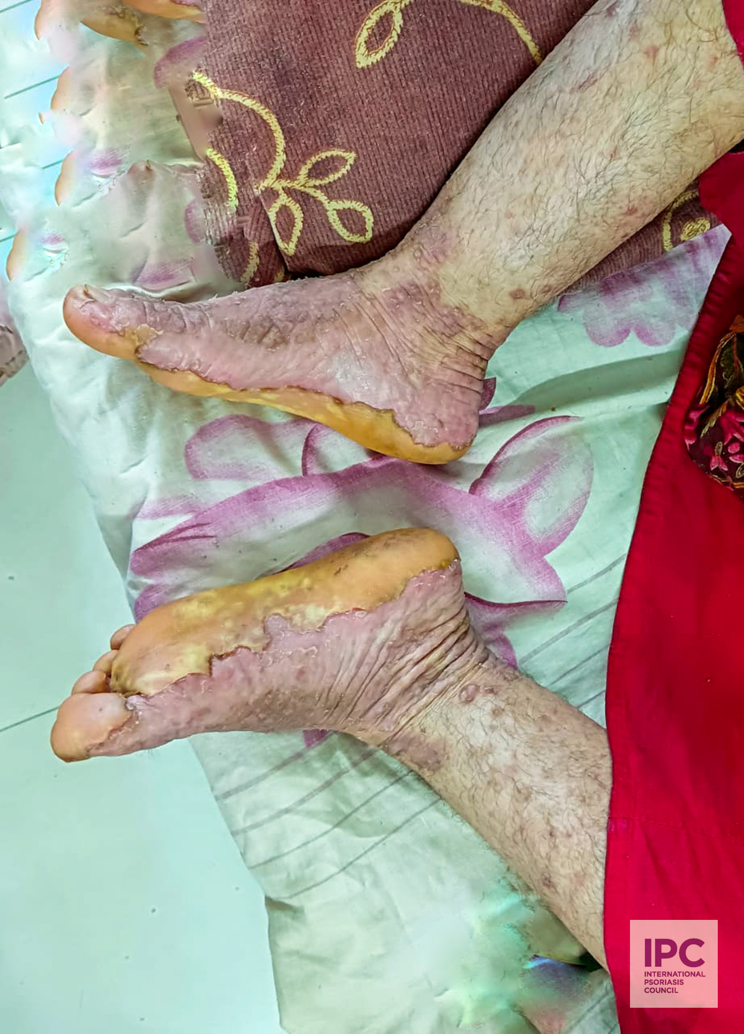 Patient presented with numerous scaly plaque on almost all of her body including scalp. There was hyperkeratosis of the palms and soles as well.