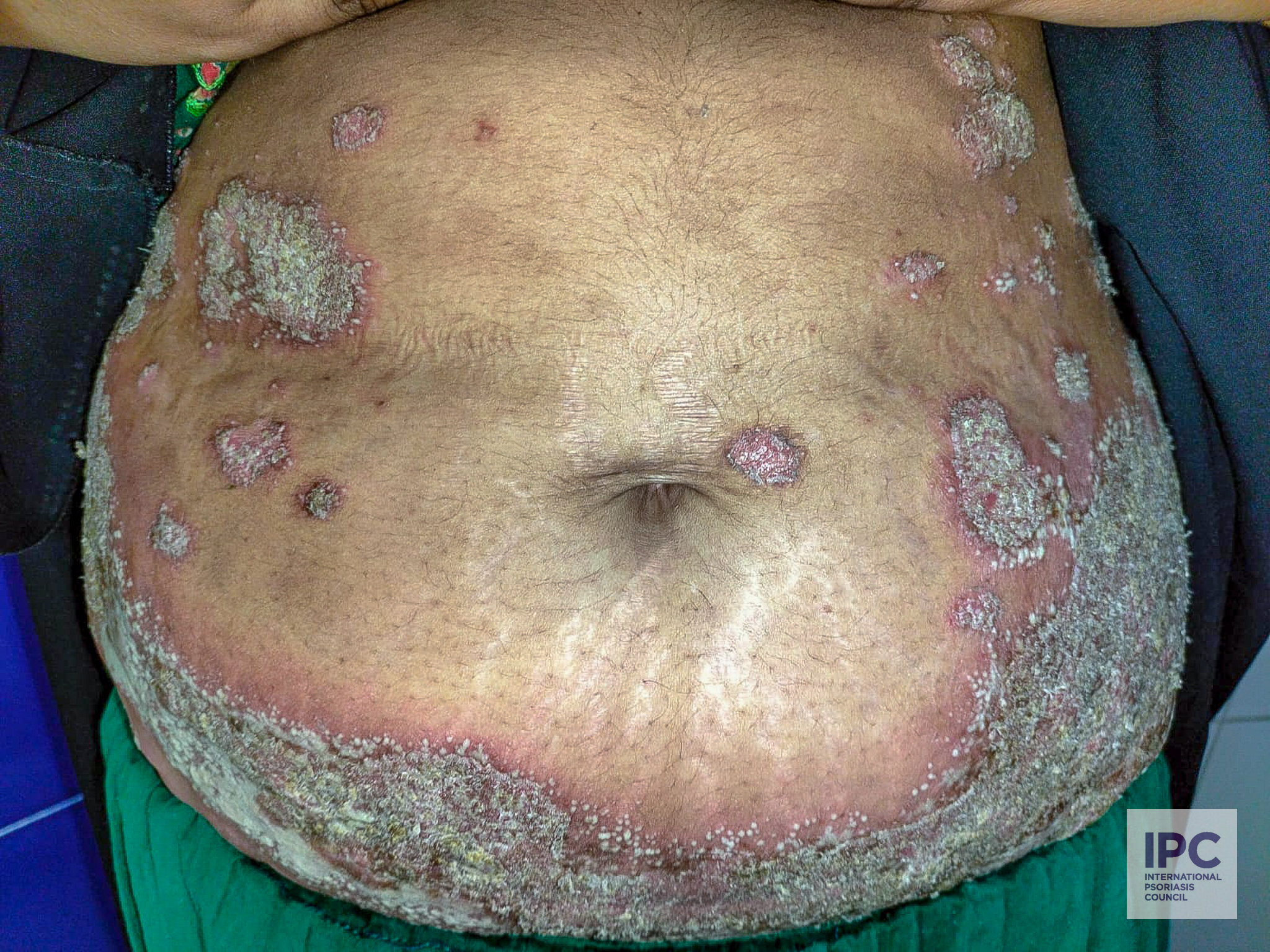 A patient with pustular psoriasis presented with purple plaque on the abdomen with pustules and crust.