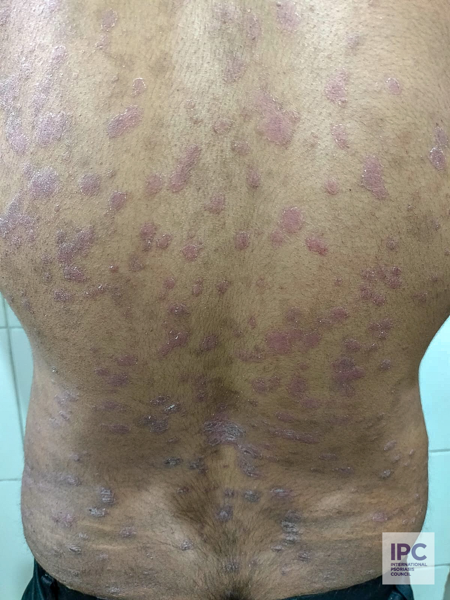 A 25-year-old male suffering with a guttate type of psoriasis. Presented with purplish small plaque involving his whole trunk.