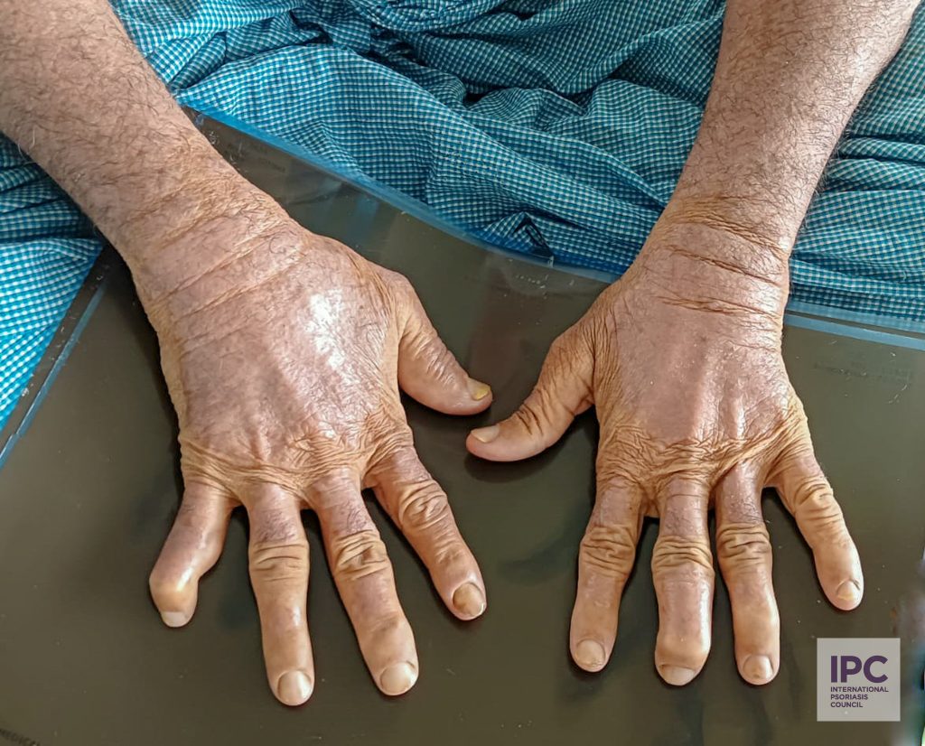 A middle aged male patient presented with numerous hyperkeratotic plaque type lesions predominantly on both extremities with deformity in a few digits. Patient was on treatment with topical steroid.