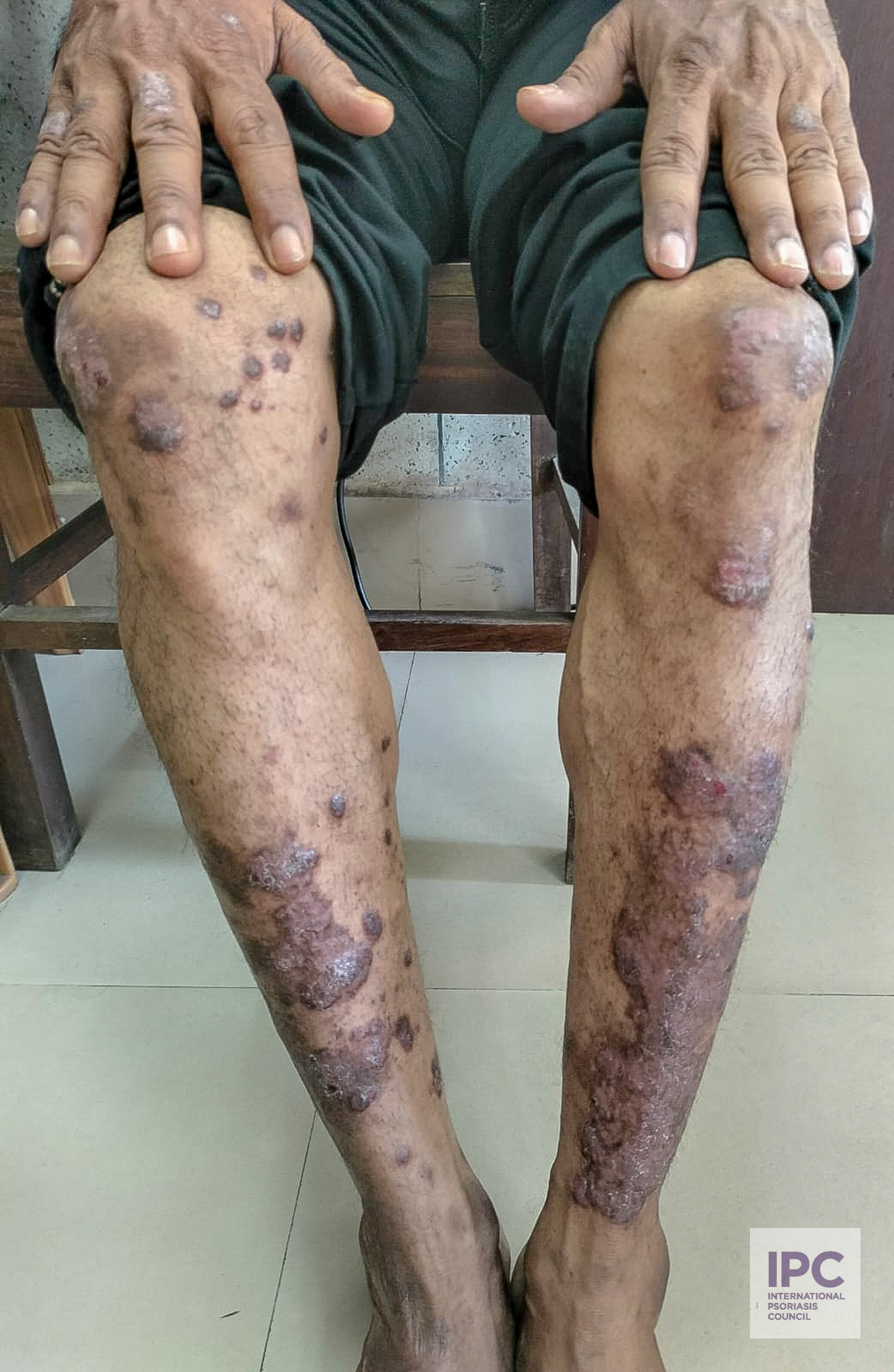 26 -year-old male patient with plaque psoriasis presented with purple, indurated plaques. Plaques have slight scaling over the extensor extremities, including knees, and hands.