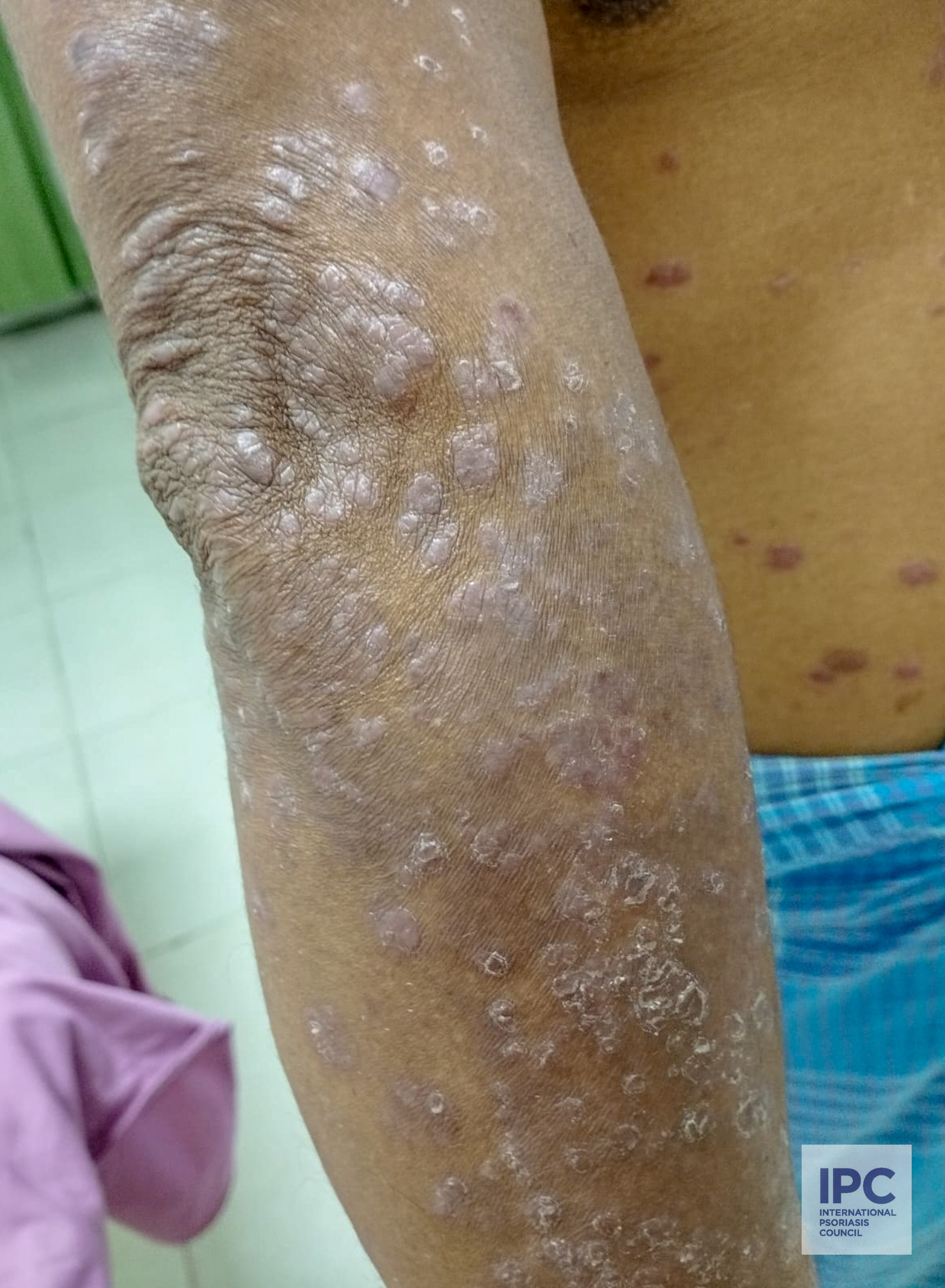 A 39 -year-old male patient with psoriasis vulgaris presented with less pink plaques with slight scaling on the extensor surface of his arms and trunk.