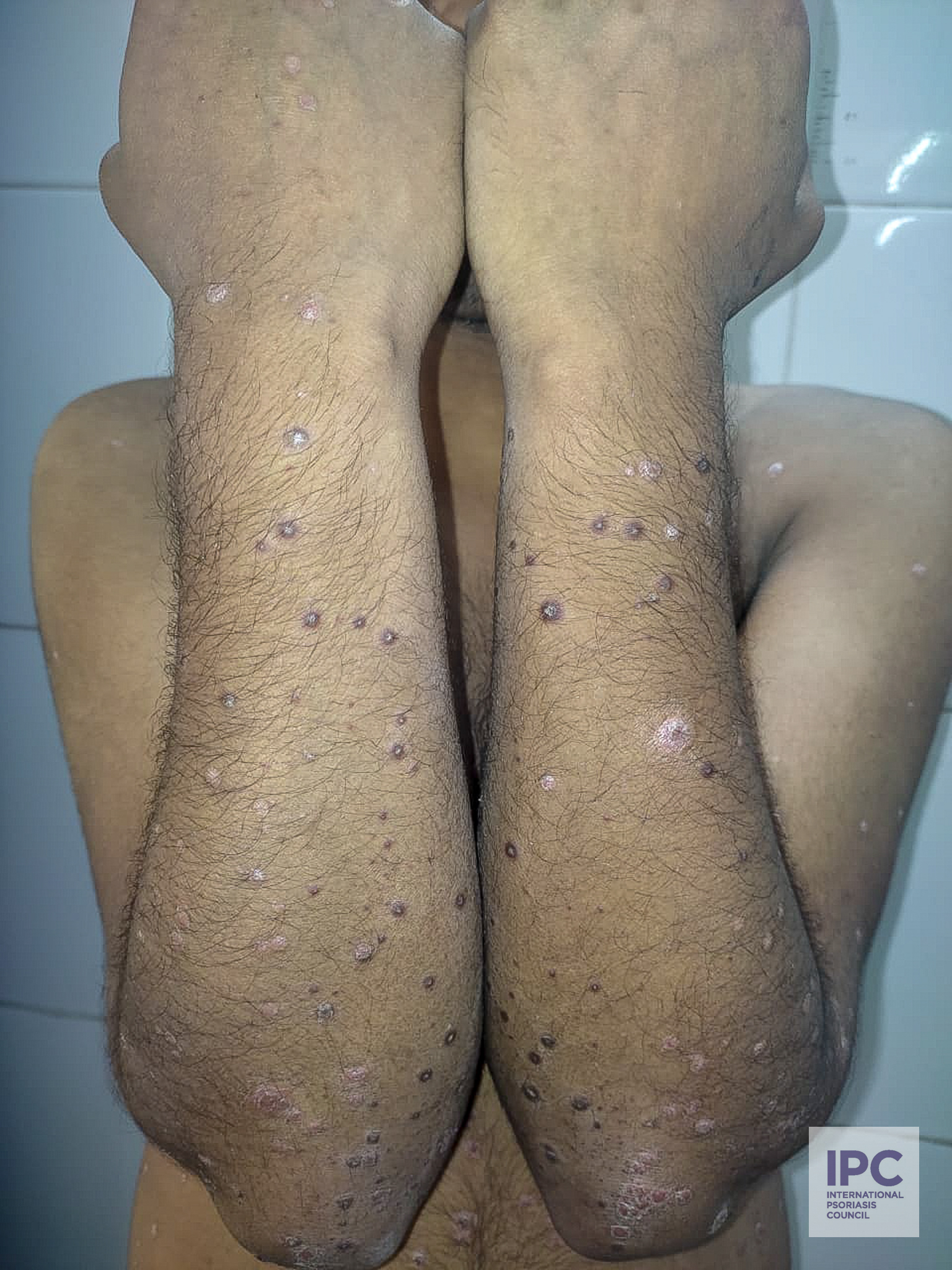 An 18-year-old male with guttate psoriasis presented with small purple and less pink plaques with some scaling over the extensor arms and trunk.