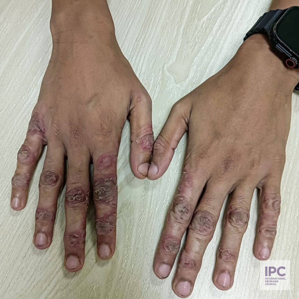 A 22-year-old male patient presents with erythematous, hyperkeratotic plaques with thick scales on the knuckles of both hands.