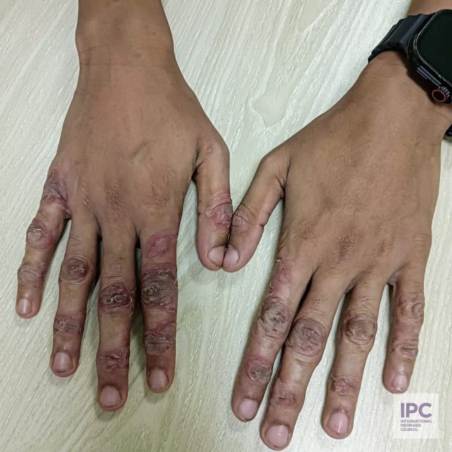 A 22-year-old male patient presents with erythematous, hyperkeratotic plaques with thick scales on the knuckles of both hands.