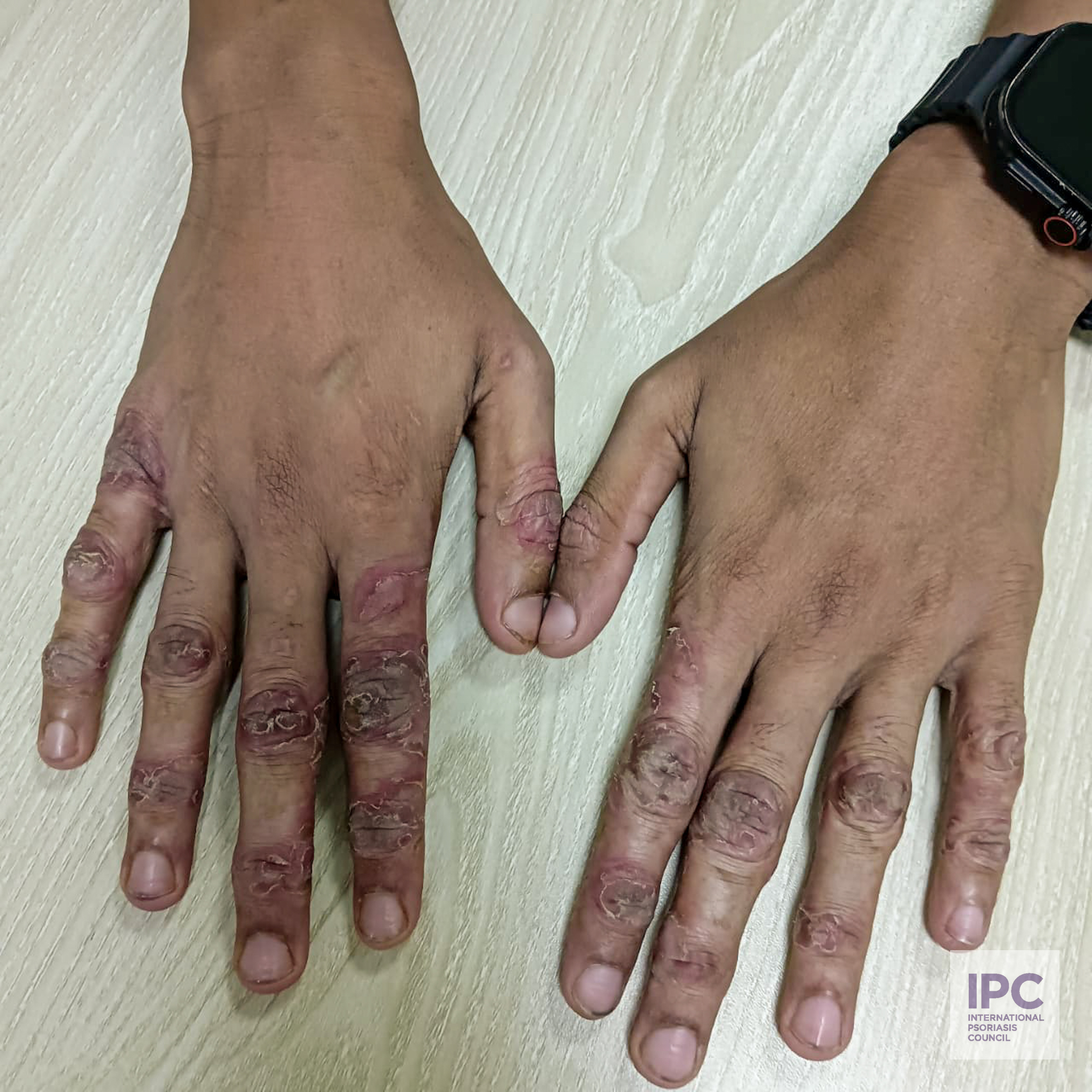 A 22-year-old male patient presents with erythematous, hyperkeratotic plaques with thick scales on the knuckles of both hands.