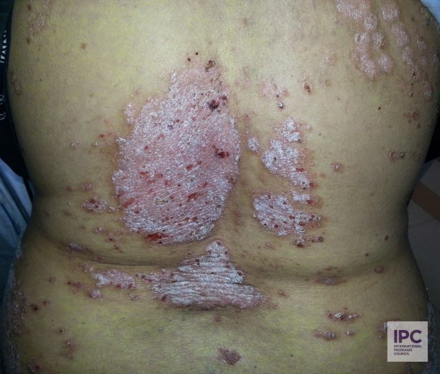 Patient presents with purplish lesions with extensive itching.