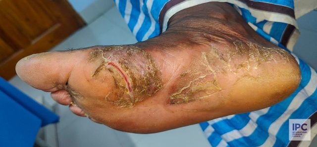 A 56 -year-old male patient with palmoplantar psoriasis, presents with hyperkeratosis, thick scale and fissure with less pinkish hue on the lesion.