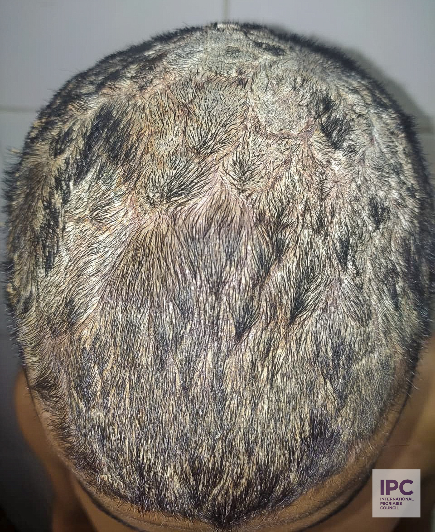 A 32-year-old male patient presents with scalp psoriasis with rough thick scales and some cracks.