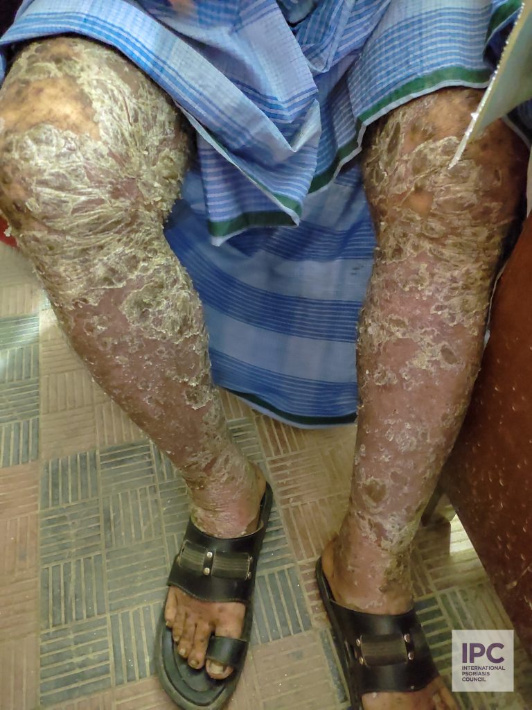A 55 -year-old male patient with psoriasis vulgaris presents with thick rough scales with fissuring on an erythematous base present on the lower limbs.
