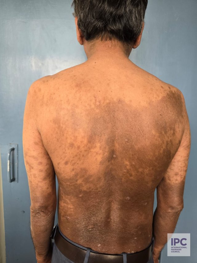 Patient presents with PIH over back following clearance of psoriasis lesions. Patient was treated with Methotrexate.