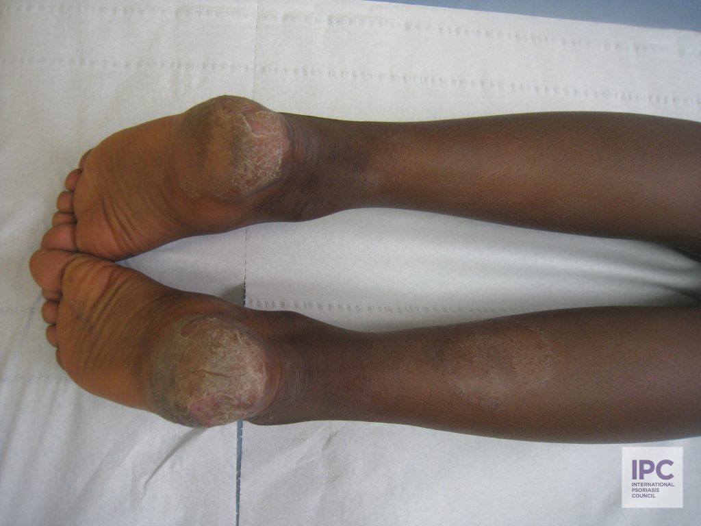 A young patient presents with severe plantar psoriasis.