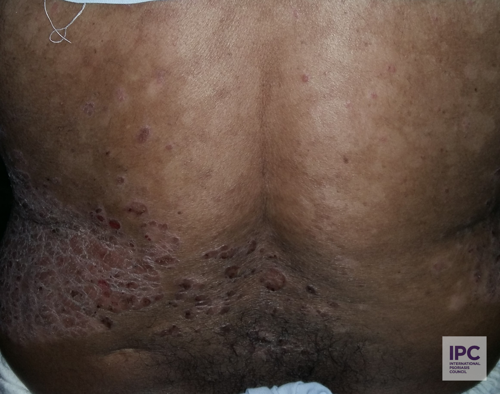Patient presents with brown colored lesions. Post inflammatory hypopigmentation appears at the top with active lesions.