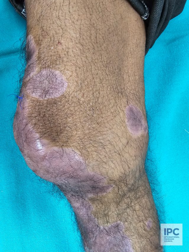 Patient with psoriasis presented with lichenoid or purple hue.