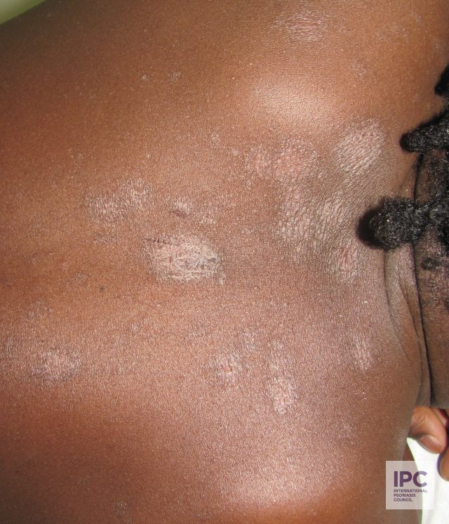 A young patient presents with hypopigmented plaque psoriasis.
