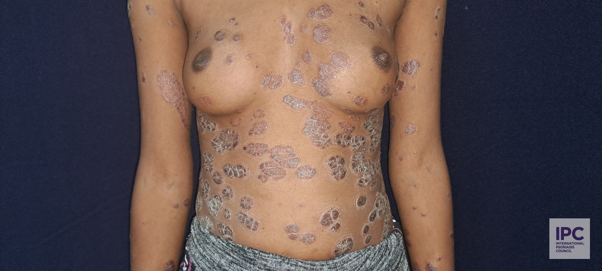 A 27-year-old female presented with skin lesions that have been present for 3 years. Traditional medicine was tried with no improvement.