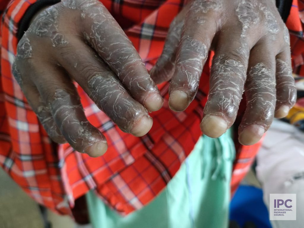 Patient presented to our health facility with longstanding untreated psoriasis.