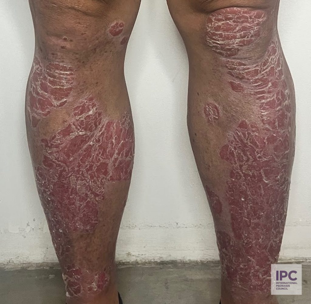 62-year-old patient presents with plaque type psoriasis mainly on his legs. previously worked in the mines of an island in southern philippines. Hypertensive, overweight to obese. Photocontact and Photodrug Dermatitis