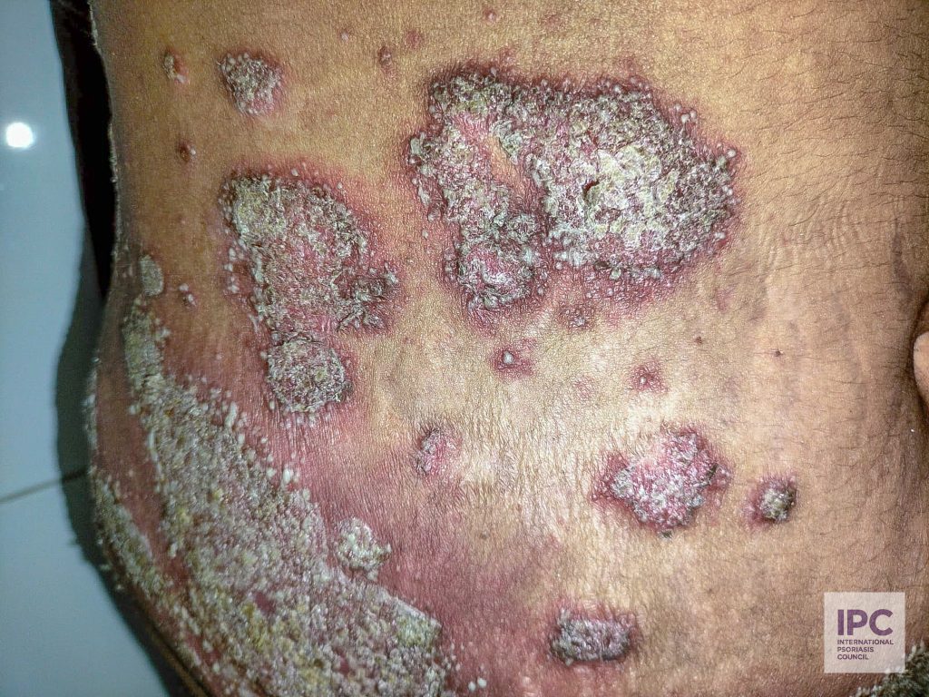 A 36-year-old male patient presents with pustular psoriasis involving the trunk. The plaques are large with tiny pustules in the vicinity of the lesion with erythematous base.