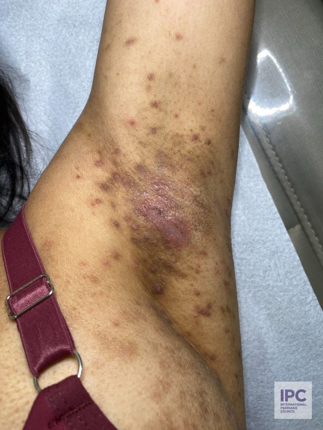 Patient has psoriasis confirmed by a skin biopsy. The patient presents with different types of lesions; plaque to patches and some pustular lesions.