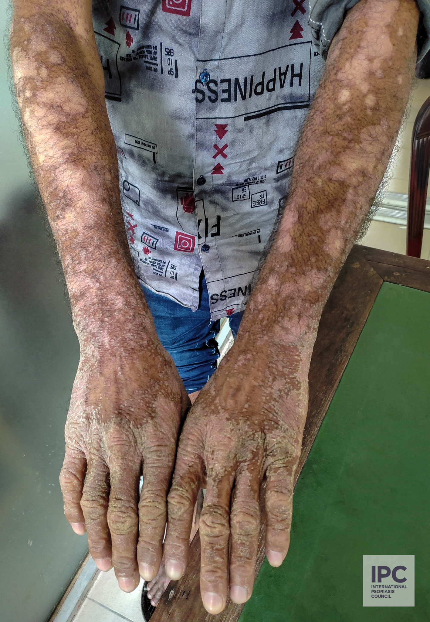 A 31-year-old male patient with plaque psoriasis. Patient presented with a prolonged history of topical steroid use, showing drug induced hypopigmentation on the arms with scaling on the dorsal aspect of both hands.