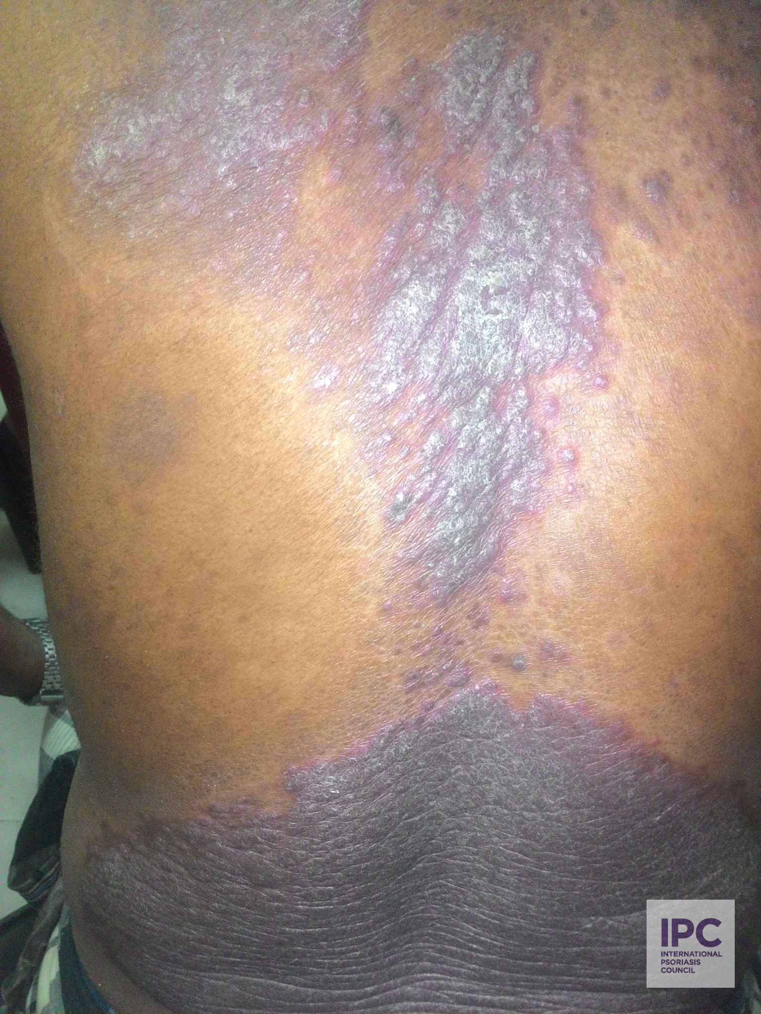 A middle aged male patient presented with purplish plaques. They have been present on his back for several months, but he has not received any treatment.