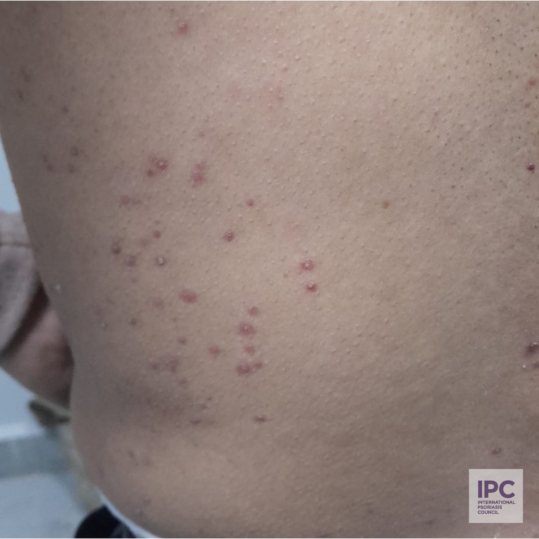 45-year-old patient with a history of untreated or inadequately managed psoriasis, with no significant improvement from topical treatments (e.g., corticosteroids or vitamin D analogs). Systemic therapies or biologics had not been administered. Relevant Clinical Information: The plaques presented with thick, grayish scaling and post-inflammatory hyperpigmentation on skin type V. The condition affected high-impact areas such as the scalp, palms, and soles, leading to functional impairment and reduced quality of life.