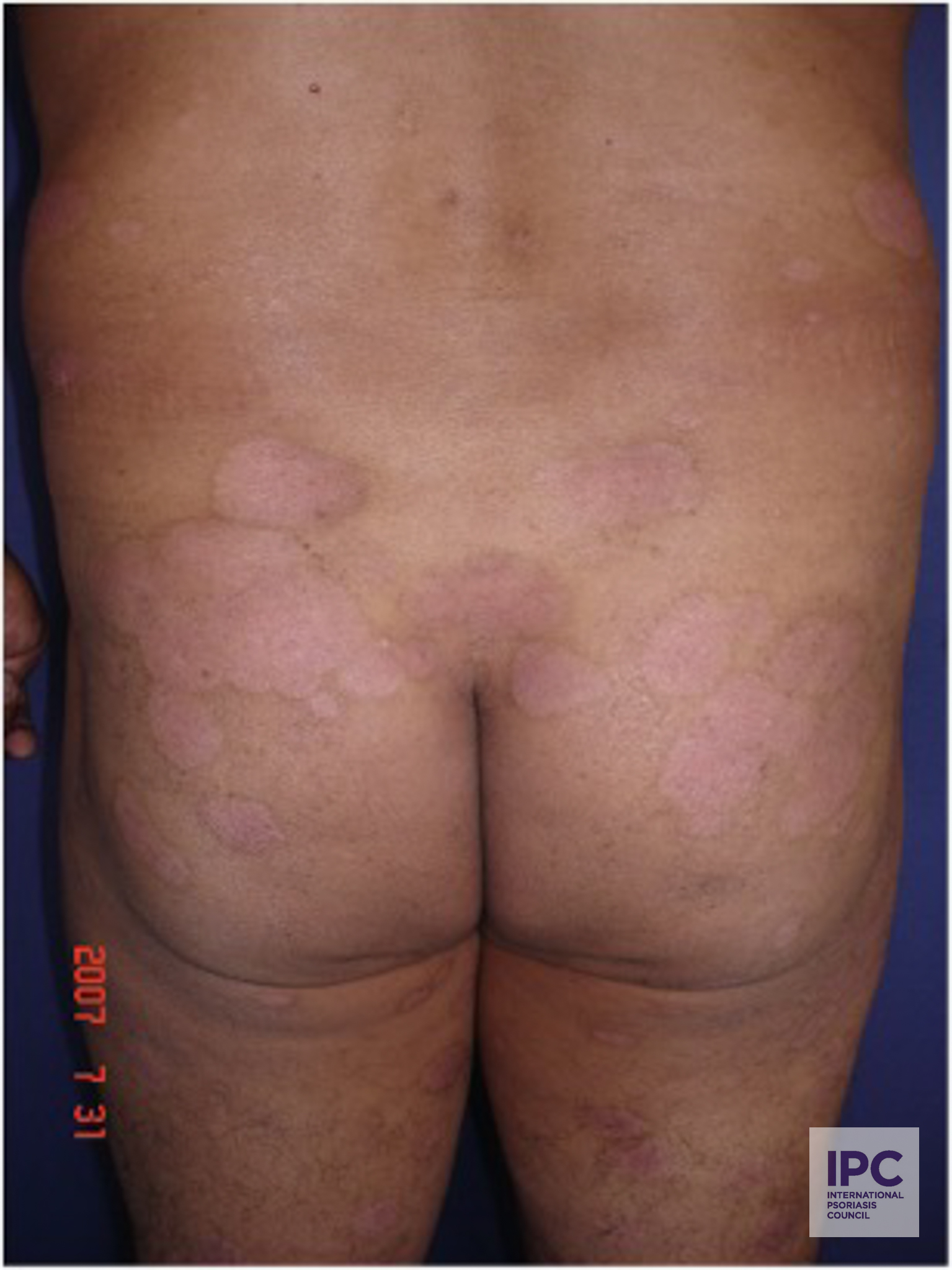 Post-Inflammatory Hyper/Hypopigmentation