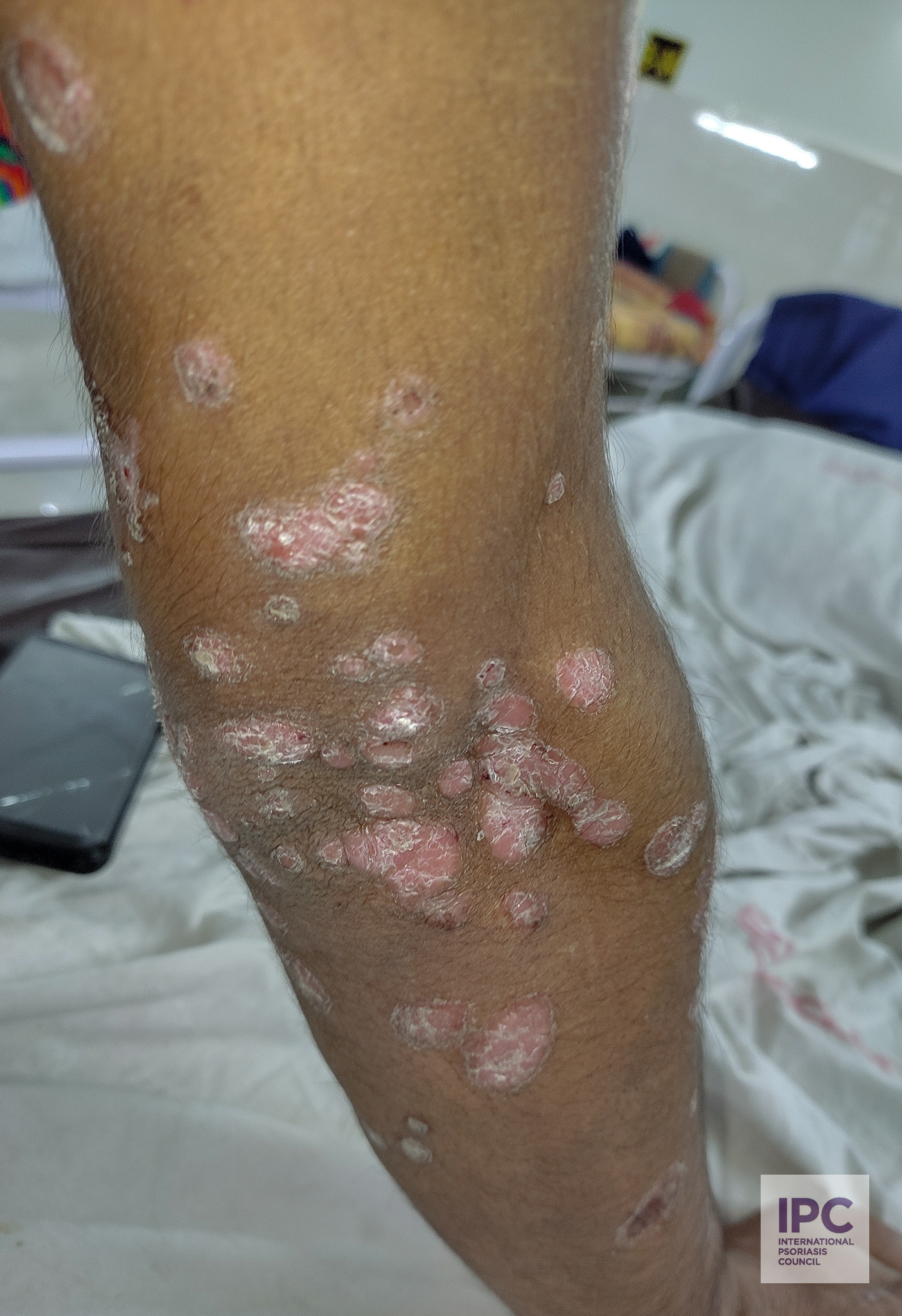 26-year-old male patient with psoriasis vulgaris presented with multiple pink plaques with scaling on the extensor surface of the arms.