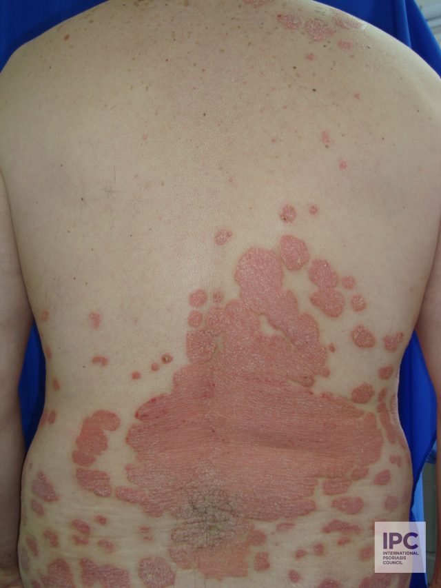 Plaque Color: Pink on Dark Skin
