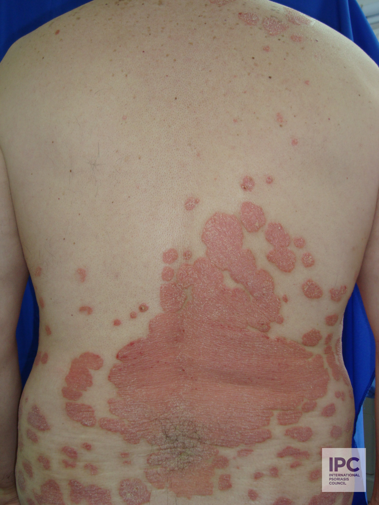 Plaque Color: Pink on Dark Skin