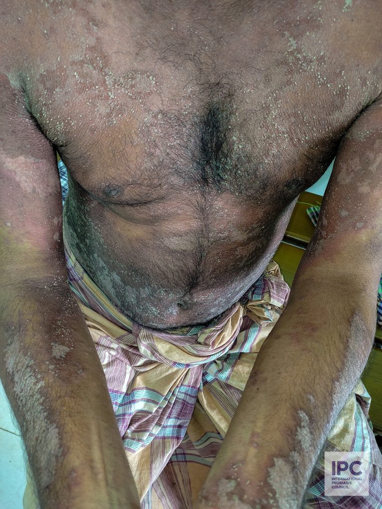 45-year-old male patient with pustular psoriasis presented with large erythematous to purple plaques with pustules and lakes of pus on the trunk and both upper extremities.