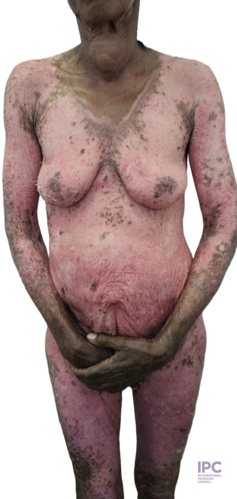 65-year-old female presented with exacerbation of pruritic rash of 3 months duration. She had history of follow-up for plaque psoriasis. Took unspecified herbal medicine & sun bathed days before exacerbation.