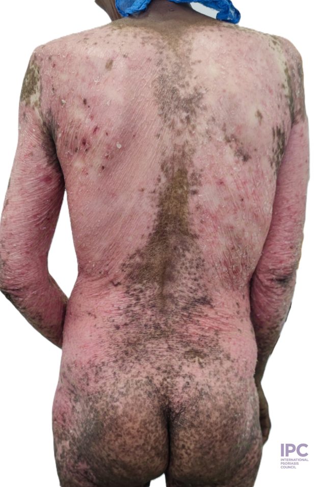 65-year-old female presented with exacerbation of pruritic rash of 3 months duration. She had history of follow-up for plaque psoriasis. Took unspecified herbal medicine & sun bathed days before exacerbation.