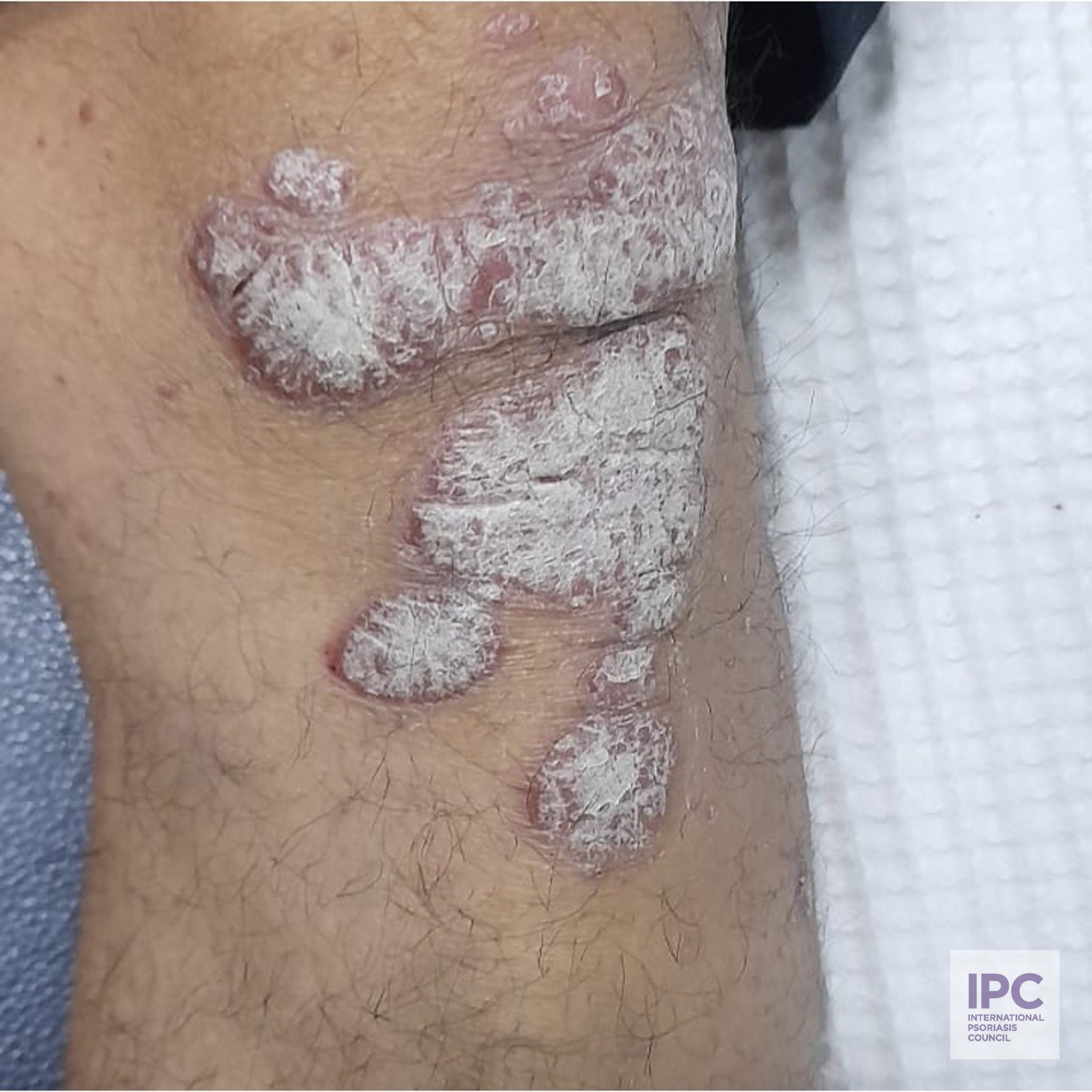 45-year-old patient with a history of untreated or inadequately managed psoriasis, with no significant improvement from topical treatments (e.g., corticosteroids or vitamin D analogs). Systemic therapies or biologics had not been administered.Relevant Clinical Information: The plaques presented with thick, grayish scaling and post-inflammatory hyperpigmentation on skin type V. The condition affected high-impact areas such as the scalp, palms, and soles, leading to functional impairment and reduced quality of life.