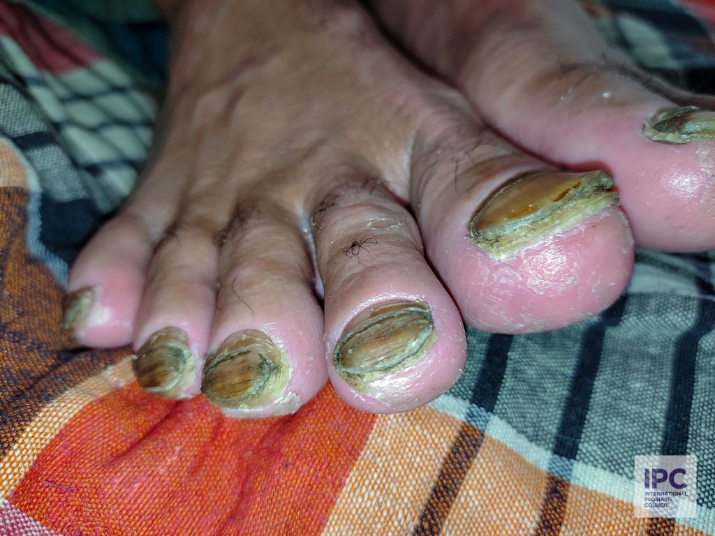 A male patient with erythrodermic psoriasis presented with ridging, pitting, oil spots on the nails with subungual hyperkeratosis and mild onycholysis on all toenails.