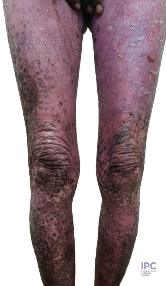 65-year-old female presented with exacerbation of pruritic rash of 3 months duration. She had history of follow-up for plaque psoriasis. Took unspecified herbal medicine & sun bathed days before exacerbation.