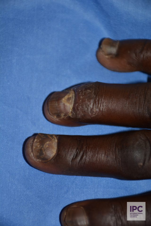 Nail psoriasis